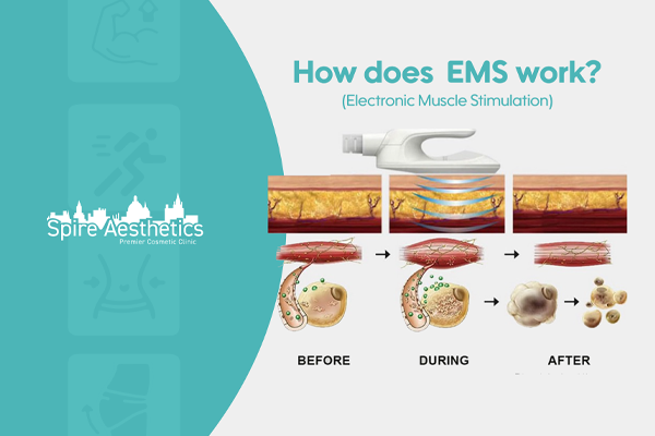 EMS treatment for post pregnancy weight loss treatment Salisbury