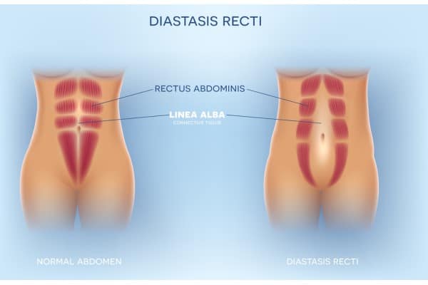 What Non-Surgical Options Are Available for Diastasis Recti Salisbury?