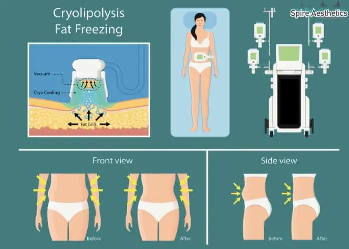 Fat freezing treatment Salisbury benefits for competitions to remove stubborn fat deposits.