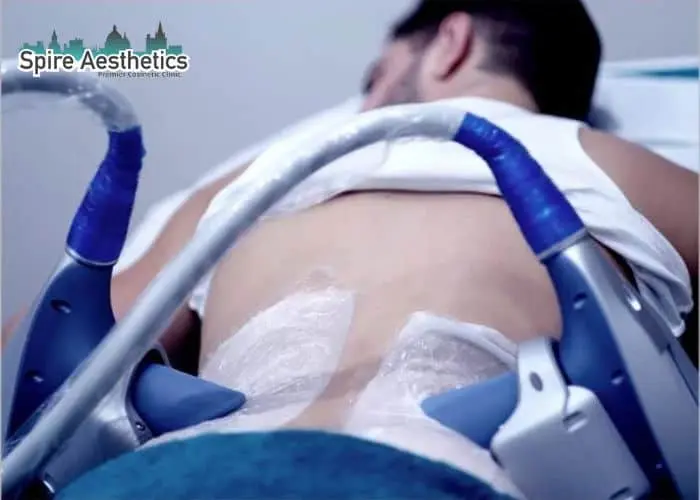 Man having fat freezing treatment done on love handles before a competitions Salisbury to create a sculpted look.