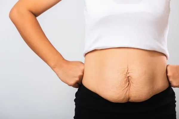 Image of a woman's stomach after weight loss with sagging skin following a gastric band Salisbury
