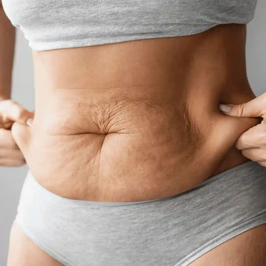 Is It Normal to Have Loose Skin After Pregnancy Salisbury?