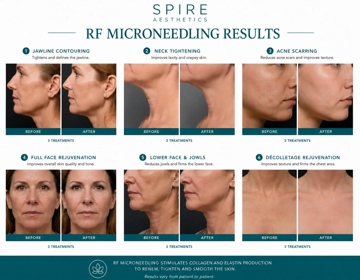 RF Microneedling Skin tightening Salisbury results