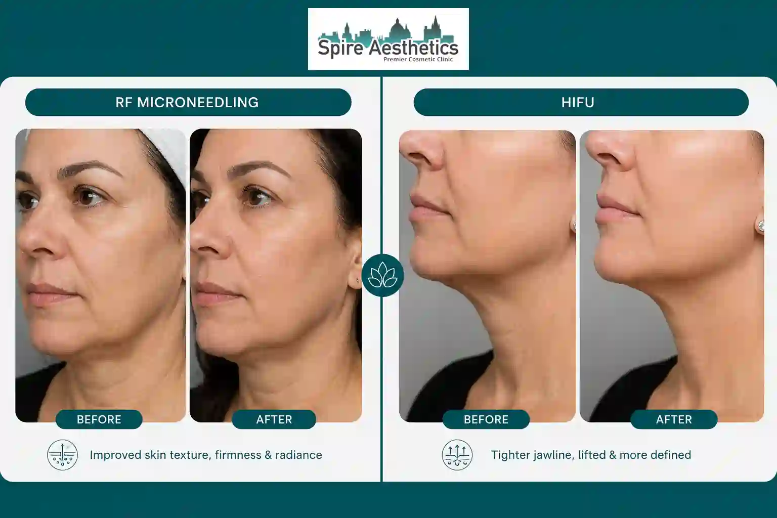 Can RF Microneedling and HIFU Be Combined Salisbury?