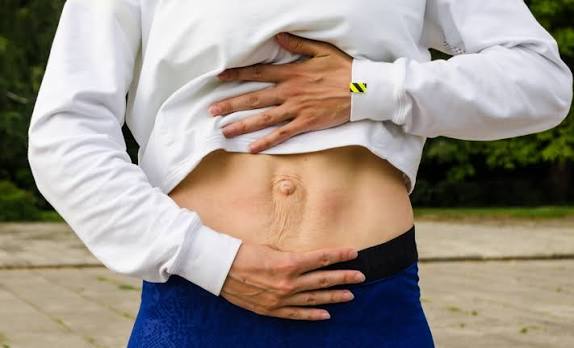 When Could Diastasis Recti Be the Missing Piece of the Puzzle Salisbury?