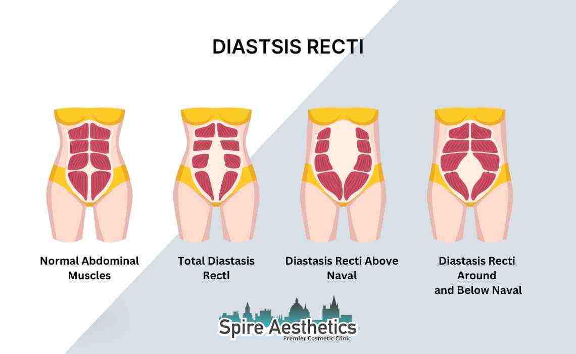 Is Non-Surgical Diastasis Recti Treatment Right for You? Common Concerns Answered Salisbury